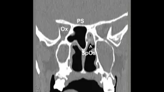 HOW TO READ A CT PNS