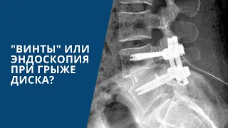 Оправданы ли страхи пациентов перед ТПФ при грыже диска?