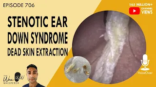 706 - Stenotic Ear Down Syndrome Dead Skin Extraction