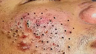 luxury daily acne treatment blackheads removal with  Nasa spa #122 2023