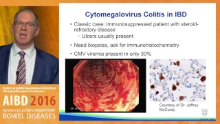 Diagnosis and management of infections in IBD patients on immunomodulators and biologics