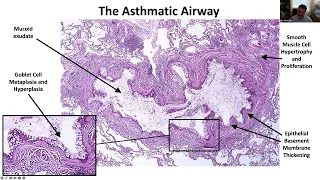 Dr. Amir Zeki - Critical Care Management of Asthma (+ Q&A)