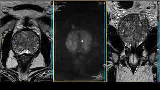 Prostate MRI — PI-RADS 2