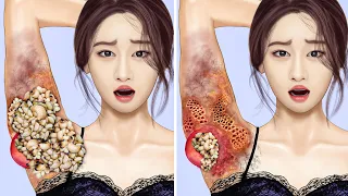 ASMR Removal Big Acne & Maggot Infected Armpit | Severely Injured Animation
