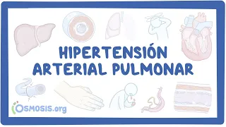 NORD - Hipertensión Arterial Pulmonar