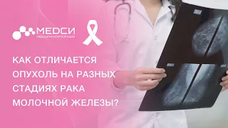 Стадии рака молочной железы // РМЖ 1,2,3,4 стадии #рмж #ракмолочнойжелезы #медси