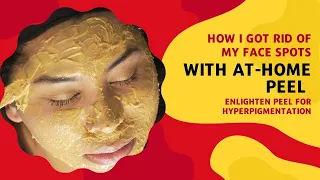 How I Got Rid Of My Face Spots With At-Home Peel | Enlighten Peel for Hyperpigmentation | Dr. Emer