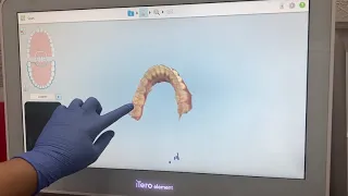 Itero for invisalign scanning