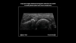 Plantar plate tear on dynamic foot ultrasound