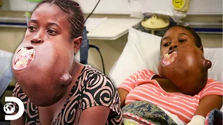 Menina do Congo enfrenta um tumor gigante na sua mandíbula | Meu Corpo, Meu Desafio