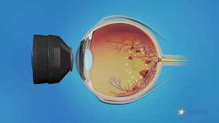 How is laser treatment for macular edema done?