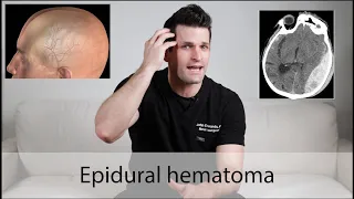 Epidural Hematoma  everything you need to know