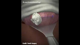 Here is how C-section is done. (Credit: Touch Surgery)