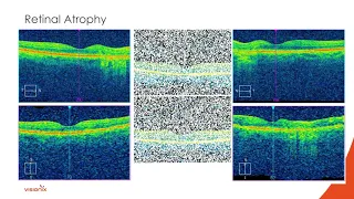 Interpreting Retinal OCTs & Introducing OCT-Angiography, Part 1 with Dr. Nathan Lighthizer