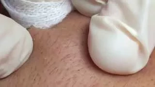 WHITEHEADS Removal