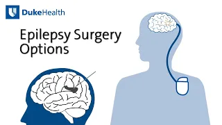 Epilepsy Surgery Options | Duke Health