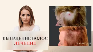 ВЫПАДЕНИЕ ВОЛОС. АЛОПЕЦИЯ. КАК ОСТАНОВИТЬ ВЫПАДЕНИЕ ВОЛОС⁉️ 😱