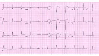 MR:EM Wellen's Syndrome