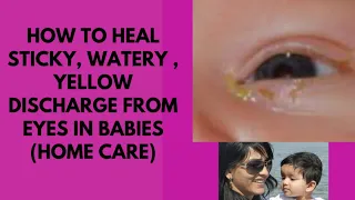 How to heal sticky, watery, yellow discharge from eyes in babies