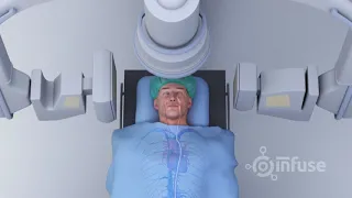 3D Medical Animation - Blood Clot Removal