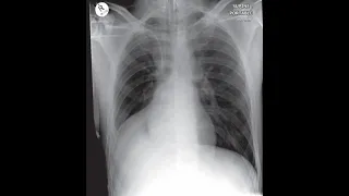 Right lower lobe collapse #Shorts Cases