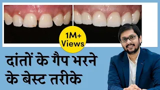 दाँतो के बीच की गैप को कैसे ठीक करें ? Close/Fill Gap In Teeth | Seraphic Dental Indore | Dr Ankit