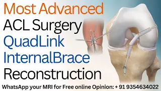 सबसे आधुनिक ACL लिगामेंट सर्जरी Most Advanced ACL Surgery - QuadLink InternalBrace Reconstruction