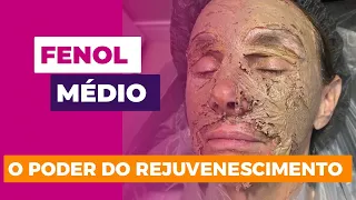 Peeling de Fenol : o poder do rejuvenescimento!!