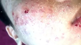 dry skin blackheads removal