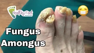 Chunky Mangled Fungal Nails