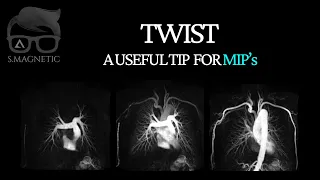 TWIST – A USEFUL TIP FOR MIP’s