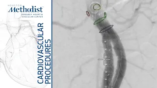 Endovascular Repair (EVAR) of Abdominal Aortic Aneurysm (M. Rahimi, MD, M. Zubair, MD, L. Gomez, MD)