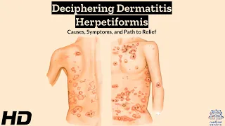 Dermatitis Herpetiformis Explained: Symptoms, Triggers, and Relief