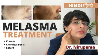 Melasma Treatment| Melasma Treatment cream| Melasma treatment laser| Melasma treatment in Hindi