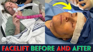 Shocking Facelift: Before, During, & After Neck Lift .. facelift surgery before and after