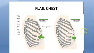 Surgery Flail Chest Paradoxical Breathing Seagull plate Rib fracture Pneumatic fixation Stove