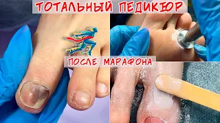 Full pedicure / Onycholysis of nails and bruise under the nail