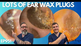 LOTS OF EAR WAX PLUGS REMOVED - EP951