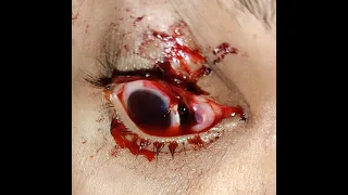 Technique for repair of large scleral tear