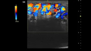 Varicocele (Grayscale and Color Doppler Imaging)