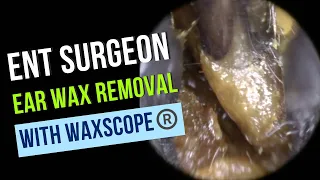 04 - ENT Surgeon Ear Wax Removal