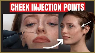 The Best Cheek Filler Injection Points | Where to inject the cheek for beautiful results.