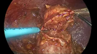 استئصال  الكلية الجزئي (ورم الكلية) با لابروسكوبي laparoscopic partial Nephrectomy 4Kد.حيدر العارضي