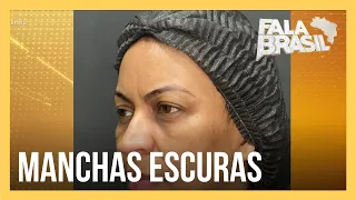 Pesquisa revela tratamento eficaz para melasma após 17 anos de estudo