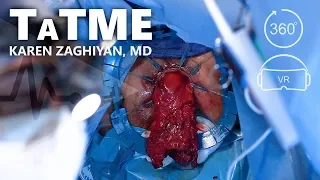 Transanal Total Mesorectal Excision (ta-TME) for Rectal Cancer - Dr. Karen Zaghiyan