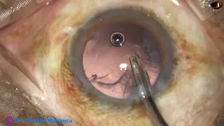 Management of a posterior subcapsular cataract : Pradip Mohanta, 21 January, 2022