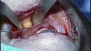 Medial lid split anterior orbitotomy