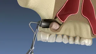 Sinus Lift (3D Animation)