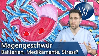 Magengeschwür: Wie gefährlich ist es & was kann ich dagegen tun? Ursachen & Therapie vom Magenulkus