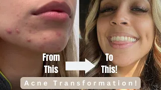 HOW I CURED MY ACNE | A complete guide to my Isotretinoin journey